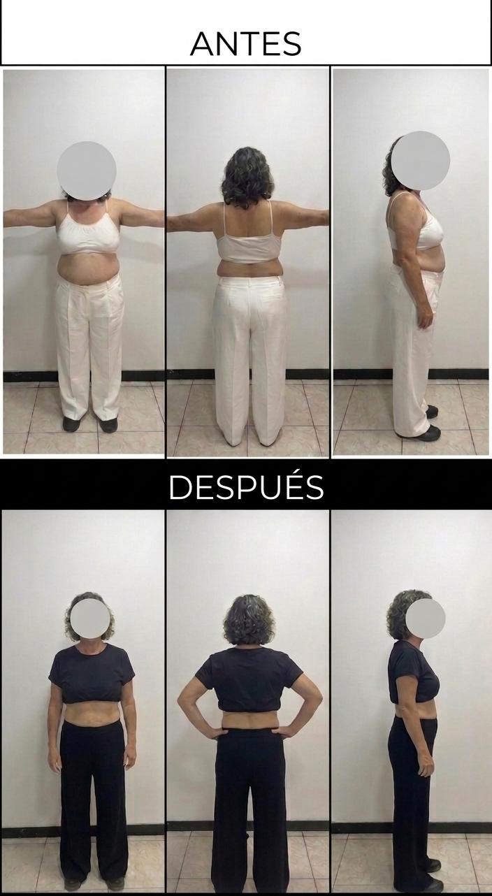 Caso 4 – DM2 + hígado graso, 66 años