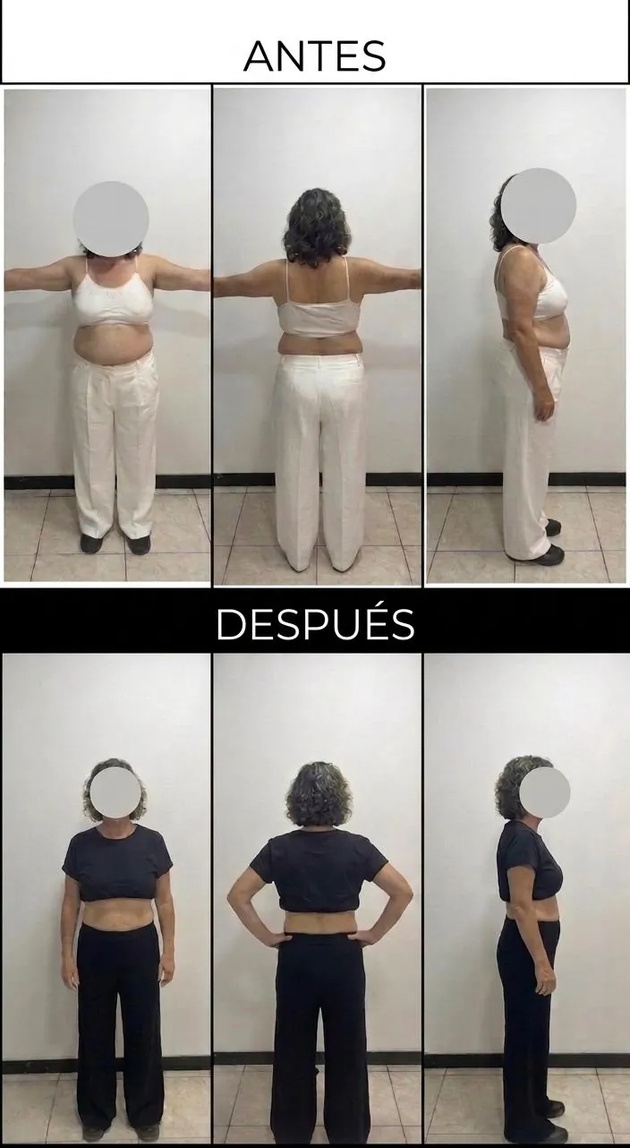 Caso clínico 4: control de diabetes tipo 2 e hígado graso sin insulina en paciente de 66 años tratado con tirzepatida